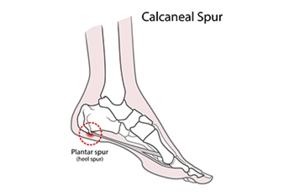 Why Heel Spurs Are Painful