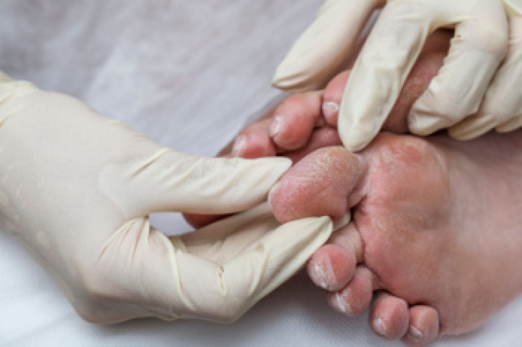 Foot Problems Caused by Diabetes