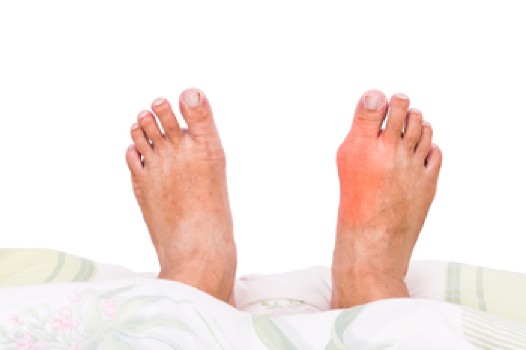 Causes and Symptoms of Bunions