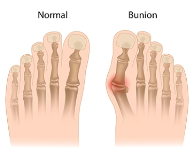 Understanding the Many Names for a Bunion