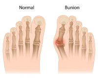 Understanding the Many Names for a Bunion