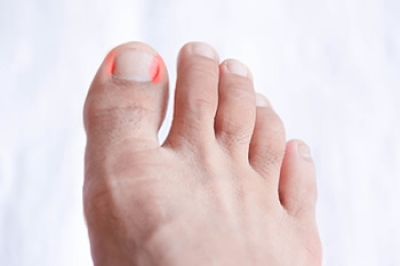 Dealing With Ingrown Toenails