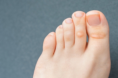 Understanding Corns and Calluses