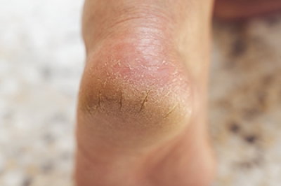 Managing Dry and Cracked Heels