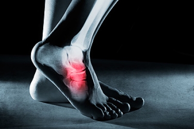 Foot Stress Fractures Can Be Common Among Runners