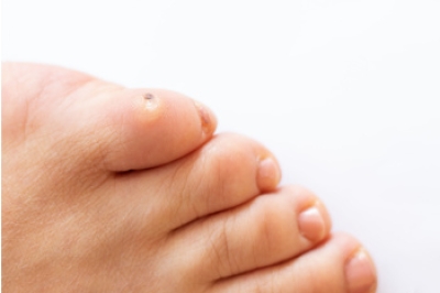 Treatment Options for Corns on the Feet
