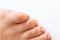 Treatment Options for Corns on the Feet