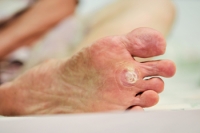 Stepping Past the Pain of Plantar Warts